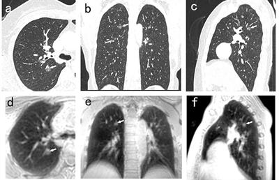 The Value of PETRA in Pulmonary Nodules of <3 cm Among Patients With Lung Cancer